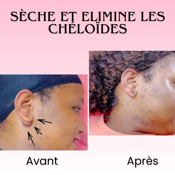Florelle Anti cicatrices